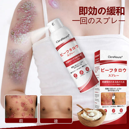 🥇CleraNaure® ビーフタロウスプレー — かゆみ・皮膚の剥がれを抑える乾癬用スキンケアスプレー