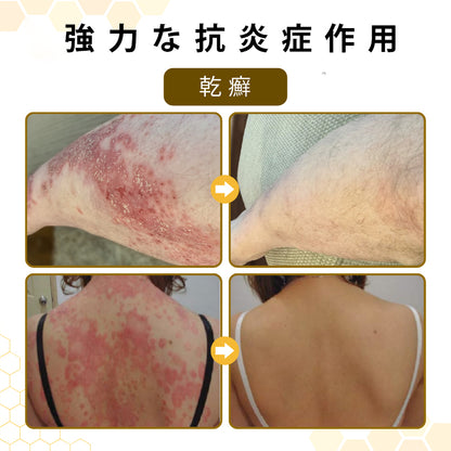 CleraNaure® プソリアスーズ ミツバチ毒配合スキンリストアクリーム