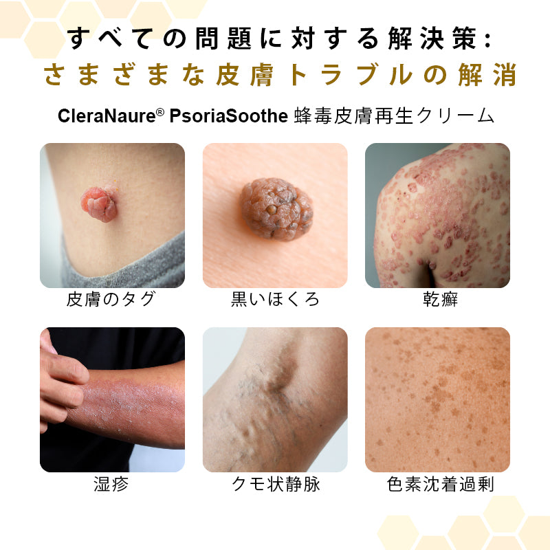 CleraNaure® プソリアスーズ ミツバチ毒配合スキンリストアクリーム