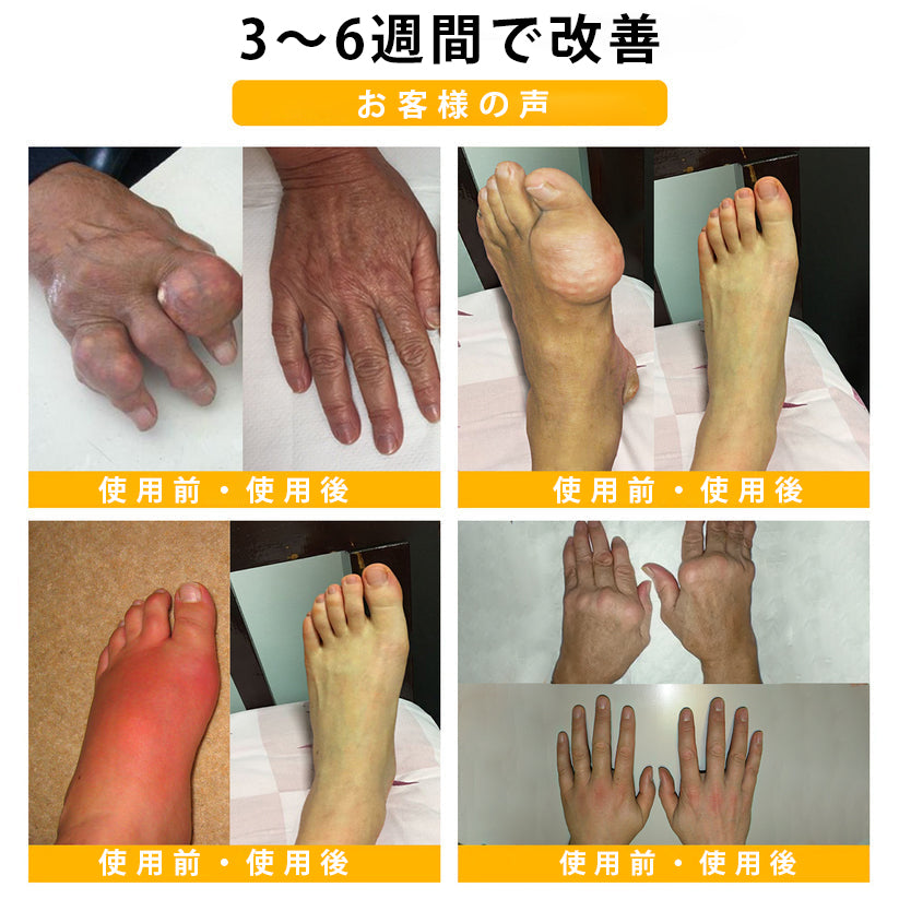 ❄️CleraNaure® ボツリヌストキシン＆蜂毒配合 鎮痛・骨癒合クリーム