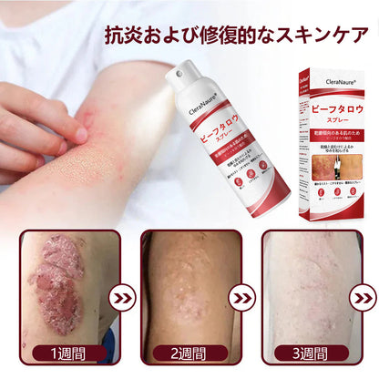 🥇CleraNaure® ビーフタロウスプレー — かゆみ・皮膚の剥がれを抑える乾癬用スキンケアスプレー